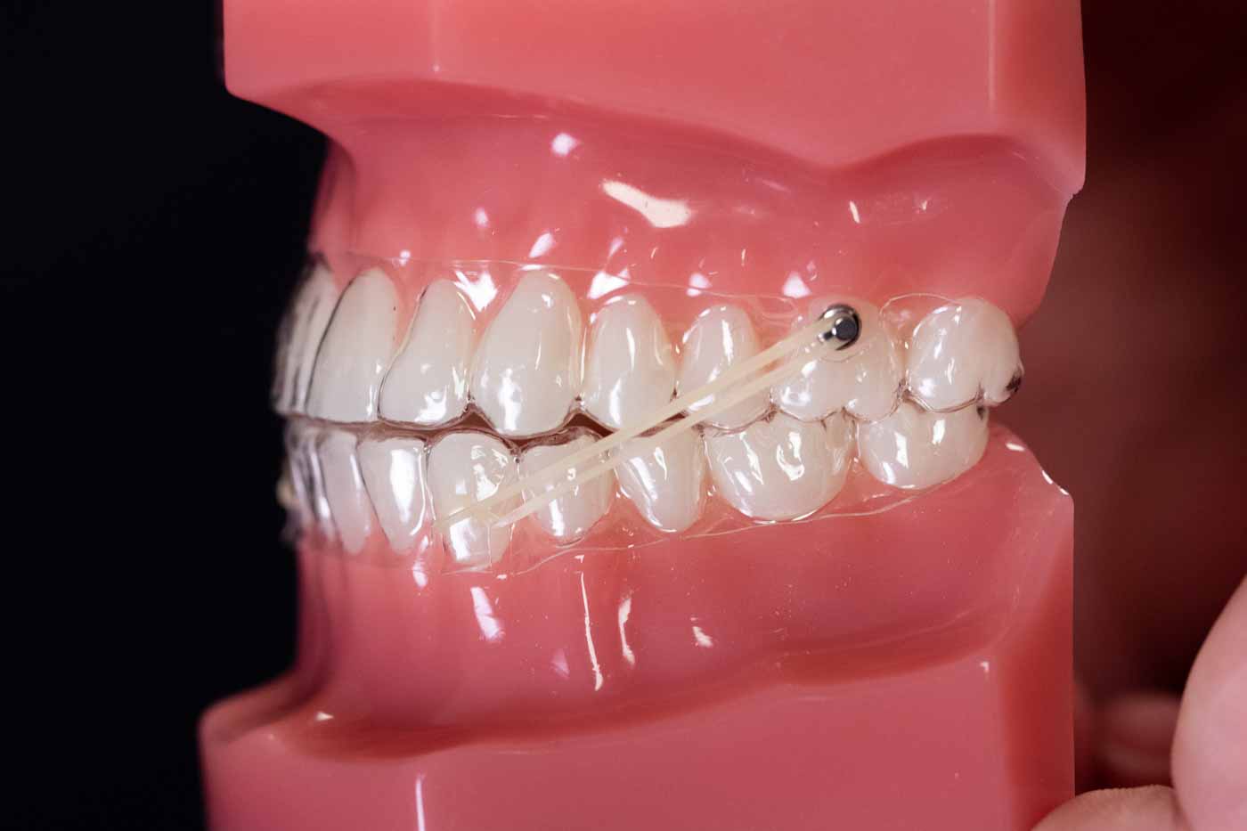 How to Use Button Cutouts with Aligners ClearCorrect Support