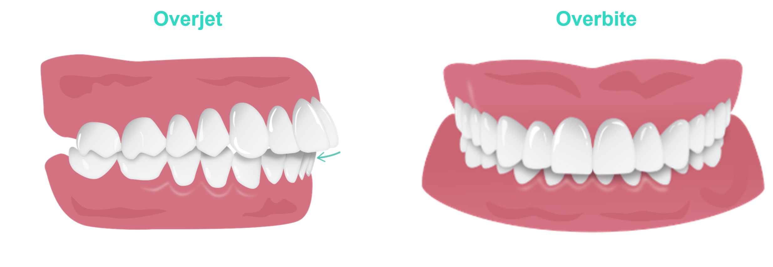 Overjet_and_Overbite.png