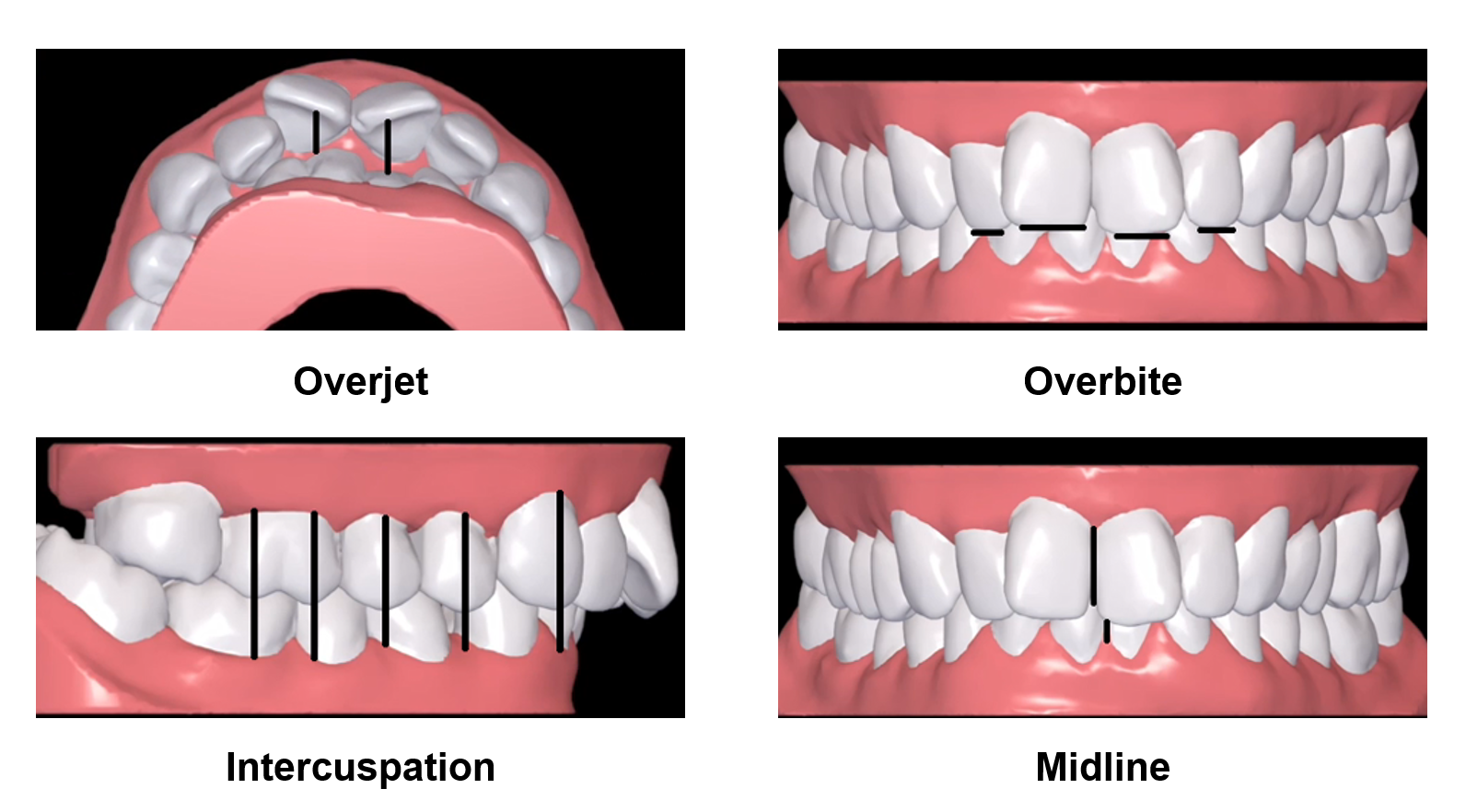 Clear Correct Aligners Patient Before and Afters - McOmie Family