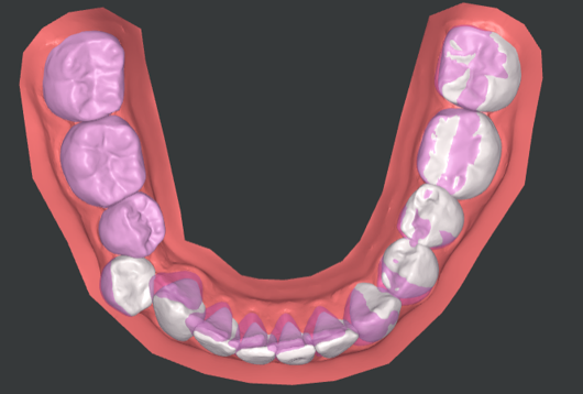 Occlusal_View_of_Lower.PNG