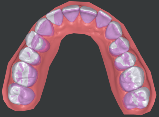 Occlusal_view_of_Upper.PNG
